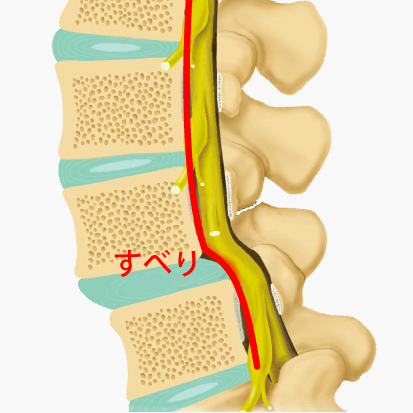 症 腰椎 すべり